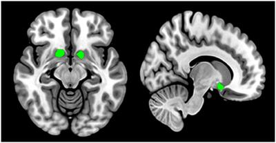 The alternations of nucleus accumbent in schizophrenia patients with auditory verbal hallucinations during low-frequency rTMS treatment